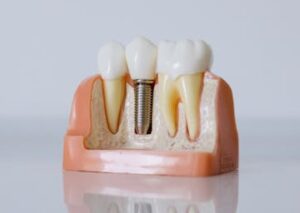 Close-Up Shot of Dental Implant Model